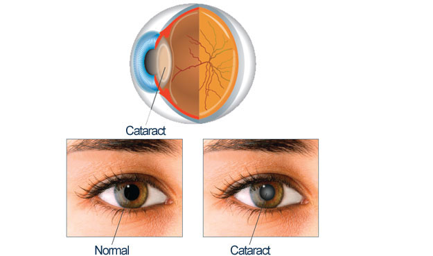 cataract